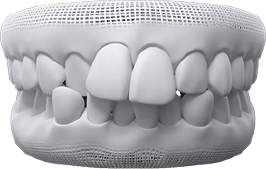 Crowded teeth treatment