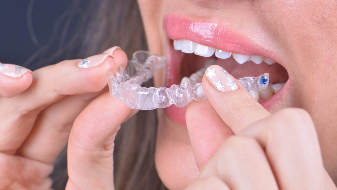 Invisalign